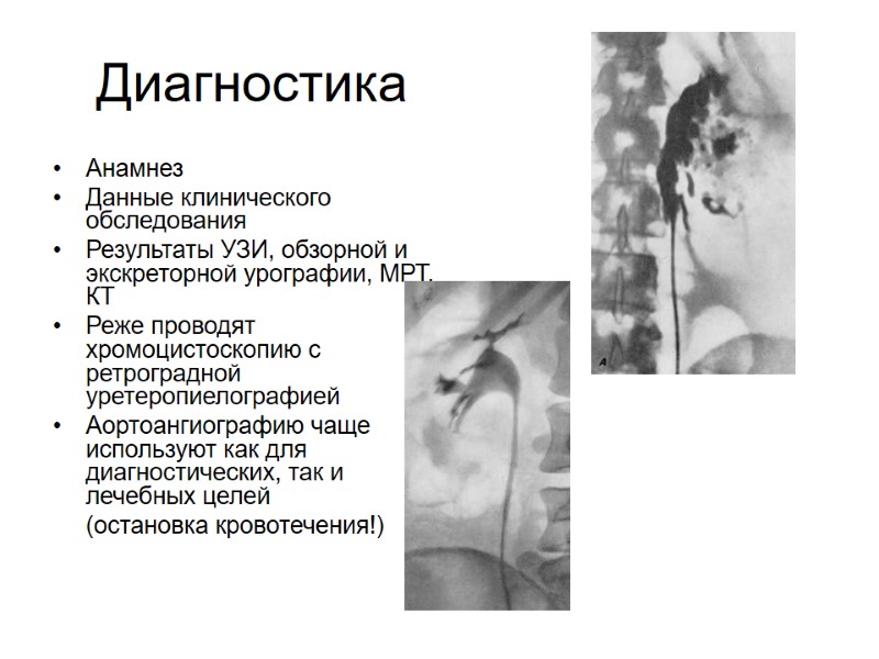 Диагностика  Анамнез Данные клинического обследования Результаты УЗИ, обзорной и экскреторной урографии, МРТ, КТ